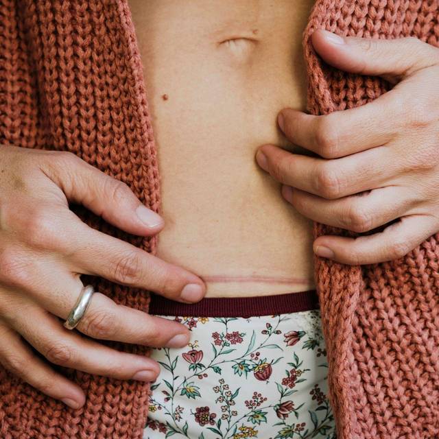 Eine Frau berührt ihre Kaiserschnittnarbe